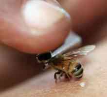 Co dělat a co odstranit otok z kousnutí vosy, včely a komáři
