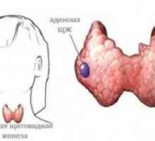 Co je adenom štítné žlázy, její typy a léčba