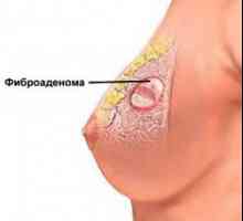 Fibroma prsu
