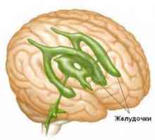 Mozek hydrocefalus u dospělých