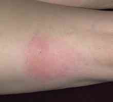 Jaké příznaky dojít při alergii na hmyzí bodnutí