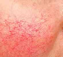 Rosacea kůže: příčiny, léčba