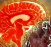 Venkovní nahrazení mozku hydrocefalus