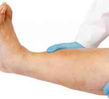Otoky nohou mužů: příčiny, léčba a prevence