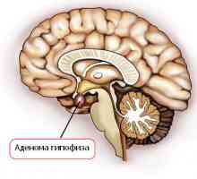 Jaké jsou příznaky adenomu hypofýzy