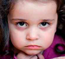 Příčiny modřin a tmavé kruhy pod očima dítěte