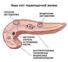 Symptomy a léčba polypů v pankreatu