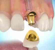 Náklady na zubní implantáty, stejně jako jejich názory