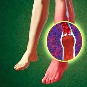 Angiopatie u diabetu: nohy a jiné orgány - nápisy, jak zacházet