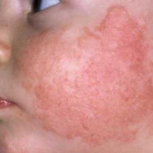 Odebrání otok z obličeje alergií