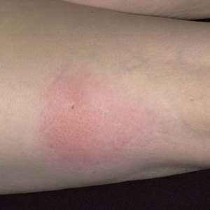 Jaké příznaky dojít při alergii na hmyzí bodnutí