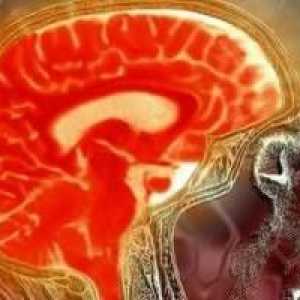 Venkovní nahrazení mozku hydrocefalus