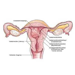 Polypy a endometrióza: Co je plná s touto kombinací?