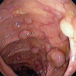 Polypy ve střevě v důsledku zánětu stěny gastrointestinálního traktu