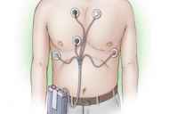 Holter monitoring (Holter monitoring) EKG a peklo: čtení, hospodářství, cena,…