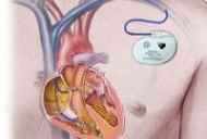Kardiostimulátor pro srdce