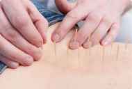 Použití akupunktury pro spinální kýly