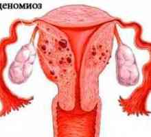 Adenomyóza a endometrióza: jak rozlišovat mezi těmito chorobami?