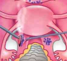Adenomyóza a endometrióza: jak se odlišit?