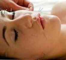 Akupunktura - nový způsob, jak face-lift bez zásahu chirurga