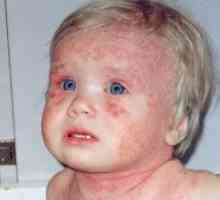 Atopické dermatitidy u dospělých a dětí