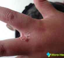 Alergický na pokožku rukou: příznaky a léčba