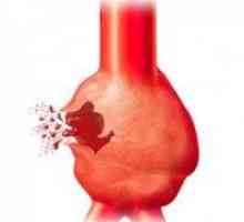 Aneurysma břišní aorty: symptomy, diagnostika, léčba