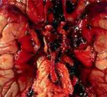 Mozek aneurysma (mozek) a její léčba