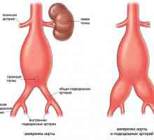 Břišní aorty v důsledku aterosklerózy