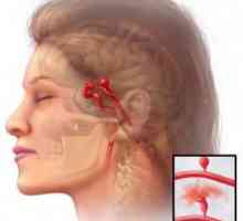 Aneurysma mozkových cév: příčiny, symptomy, efekty, chirurgie