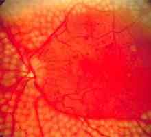 Retinální angiopatie oči a jeho léčba