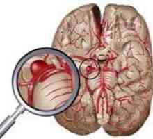Hlavními příznaky mozkové aneurysma