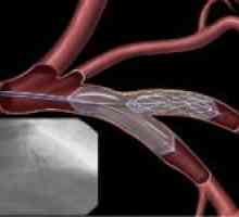 Angioplastika při léčení vaskulárních lézí