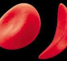 Anisocytóza červených krvinek v krevní test (index RDW)