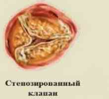 Aortální chlopeň srdce a jeho chorob