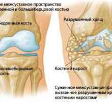 Artritida kolenního kloubu
