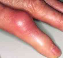Artritida kloubů prstů