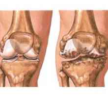 Osteoartritidy kolene (gonartróza)