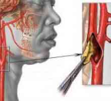 Aterosklerotické změny v krčních tepen