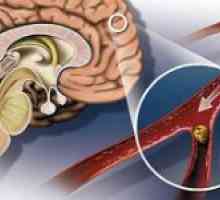 Ateroskleróza mozkových cév a jeho symptomy