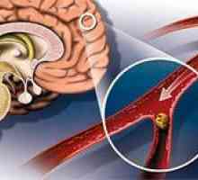 Ateroskleróza mozkových cév mozku