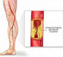 Ateroskleróza dolních končetin