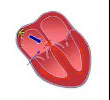 Atrioventrikulární blok (AV) srdeční: příčiny, rozsah, příznaky, diagnostika, léčba