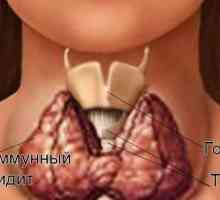 Autoimunitní onemocnění ženského štítné žlázy: příznaky destrukce a léčba thyroiditis