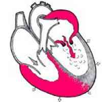Aortální nedostatečnost ventil a jeho léčba
