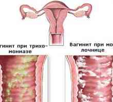 Bakteriální vaginitida nebo vulvovaginitidy (kolpitid)