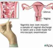 Bakteriální vaginóza (coleitis) - příznaky, diagnostika a léčba metody