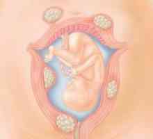 Těhotenství a porod děložní myomy