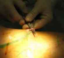 Chirurgická léčba křečové žíly v nohách