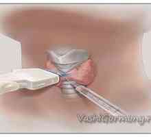 Biopsie štítné žlázy - střízlivý pohled na problém (plus svědectví pacientů)